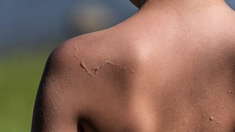 Haut am Rücken pellt sich nach Sonnenbrand. (Foto: picture-alliance / Reportdienste, picture alliance / Zoonar | Trygve Finkelsen) Haut am Rücken pellt sich nach Sonnenbrand.