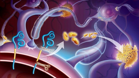 Plaques bei Alzheimer (Foto: picture-alliance / Reportdienste, JACOPIN) Plaques bei Alzheimer