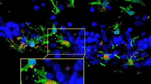 Retinitis pigmentosa ist eine unheilbare und nicht vermeidbare Augenerkrankung, von der 1 von 4.000 Menschen betroffen ist. (Foto: IMAGO, IMAGO/BSIP) Retinitis pigmentosa ist eine unheilbare und nicht vermeidbare Augenerkrankung, von der 1 von 4.000 Menschen betroffen ist.